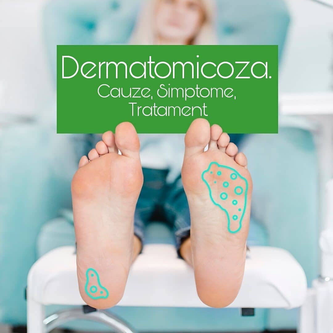 dermatomicoza